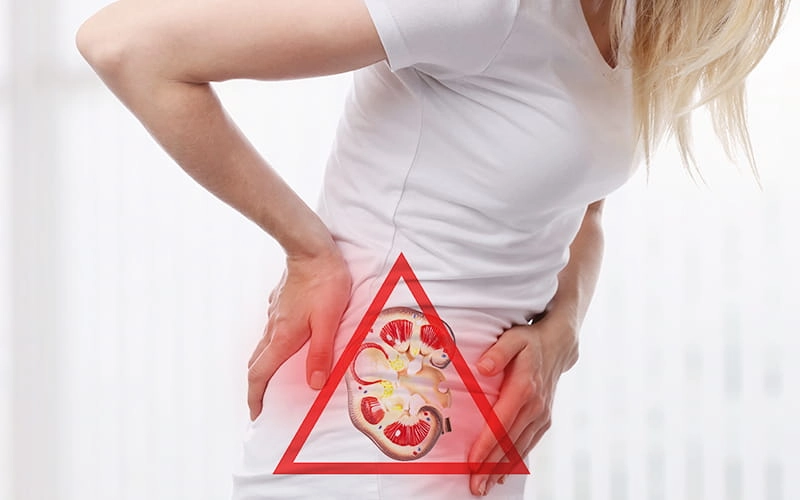 Мочекаменная болезнь (МКБ)